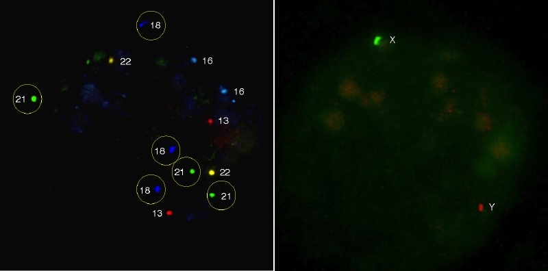 FISH法による染色体異常解析
