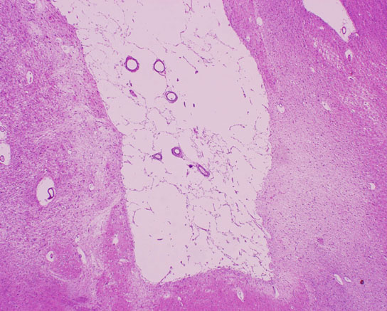 Disease