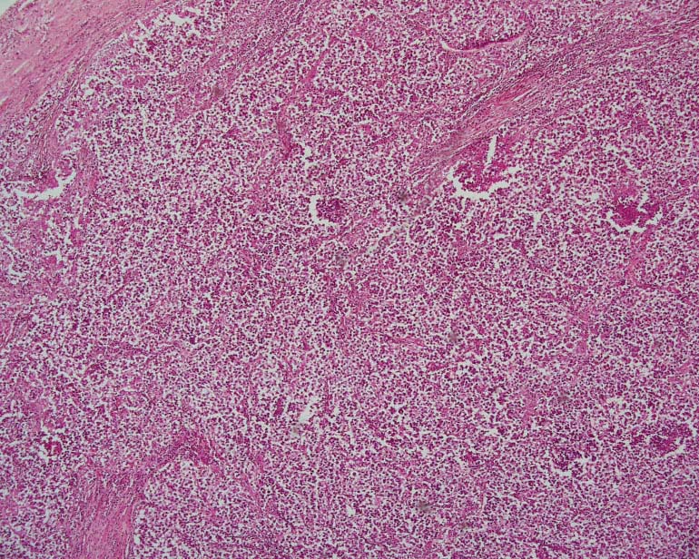 Disease