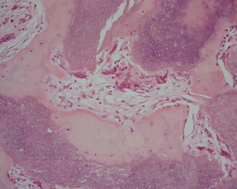 Disease