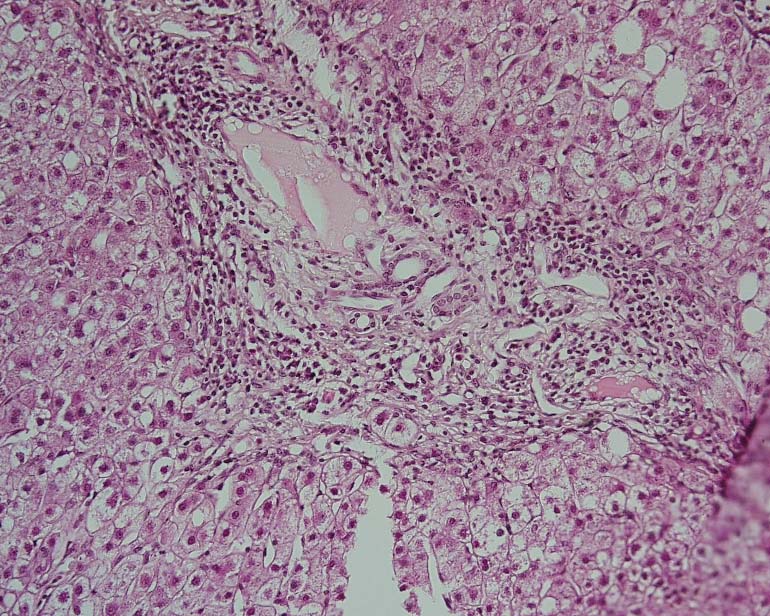 Disease